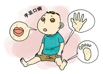 【健康知識】 あなどれない手足口病